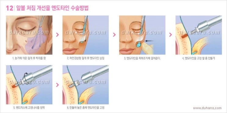 [두한성형외과 경쟁력 다크써클 치료] - [다크써클 + 엔도타인 리프팅 콤비 프로그램] 관련 이미지 13