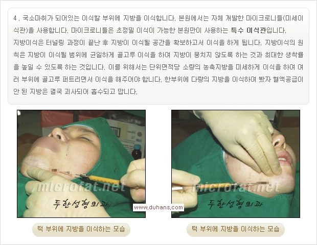 [두한성형외과 경쟁력 미세지방이식] - [부드럽고 아름다운 얼굴윤곽선 턱(하악부) 미세지방이식 안내] 관련 이미지 11
