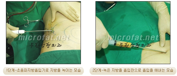 두한성형외과 지방흡입 - 부위별 안전 지방흡입 관련 이미지 9