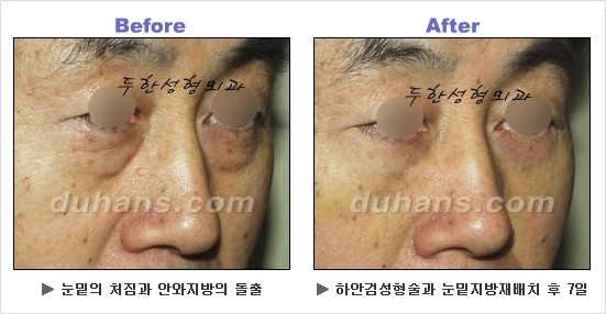 [두한성형외과 경쟁력 동안성형 리더] - ​[미간주름, 이마주름, 안검성형, 이마거상술, 눈썹거상술] 관련 이미지 101