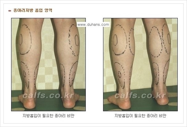 [두한성형외과 경쟁력 멀티종아리성형] - [예쁜 종아리를 만드는 종아리 지방흡입술 안내] 관련 이미지 2