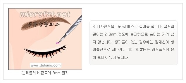 [두한성형외과 경쟁력 지방제거] - [눈밑지방제거, 눈위(윗눈꺼풀)지방제거 안내] 관련 이미지 7