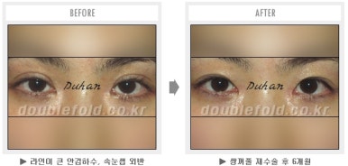 두한성형외과 쌍커풀 재수술 - 짝눈 눈매교정, 가성 안검하수 교정과 뒤밑트임 관련 이미지 35