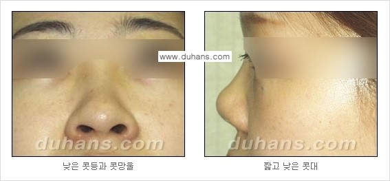 [두한성형외과 경쟁력 미세지방이식] - [코 지방이식 1.] 관련 이미지 4