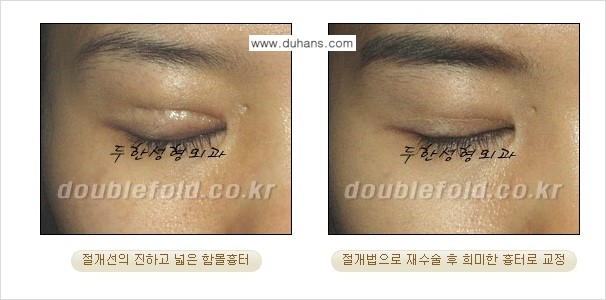[두한성형외과 쌍꺼풀 재수술] - [쌍꺼풀 재수술에서 잘못된 수술로 인한 넓어진 흉터 처리 문제] 관련 이미지 2