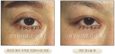 Duhan Plastic Surgery Ophthalmic Reoperation - What Is a Successful Double Eyelid Revision Surgery? image 8