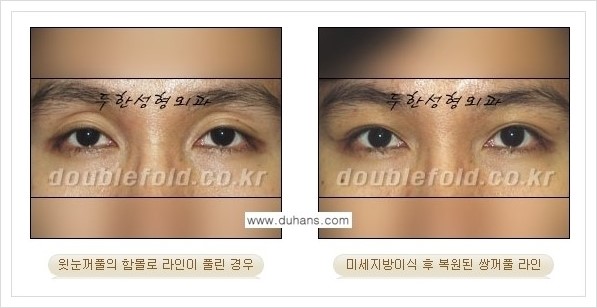 [두한성형외과 경쟁력 쌍꺼풀 재수술(극한 재수술)] - [라인이 풀렸을 경우의 쌍꺼풀 재수술 안내 ②] 관련 이미지 5