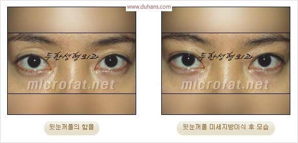 [두한성형외과 경쟁력 눈성형 리더] - [윗눈꺼풀 함몰( #꺼진눈꺼풀) 미세지방이식과 상안검성형]#꺼진눈성형 , #눈위함몰 관련 이미지 36