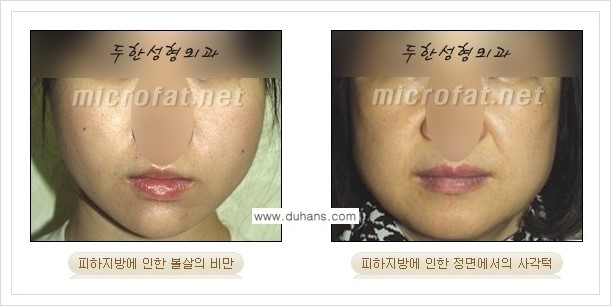 [두한성형외과 경쟁력 얼굴지방흡입] - [통통한 볼살, 두툼한 턱살(턱선)의 지방흡입] 관련 이미지 1