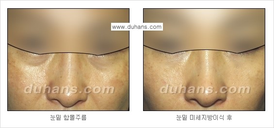 [두한성형외과 경쟁력 주름성형] - [미세지방이식을 이용한 주름교정 안내 - 눈밑주름, 입가주름, 팔자주름 2.] 관련 이미지 16