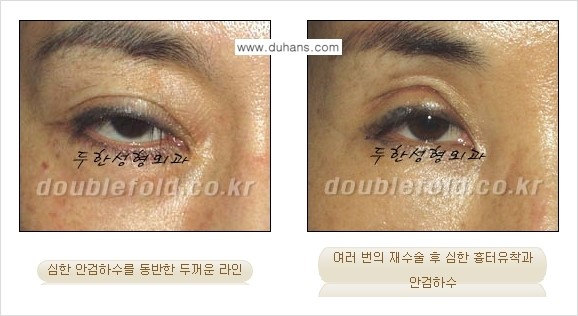[두한성형외과 무한 경쟁력 "극한 눈(쌍꺼풀) 재수술"] - [극한 눈(쌍꺼풀) 재수술 Q&A] 관련 이미지 10