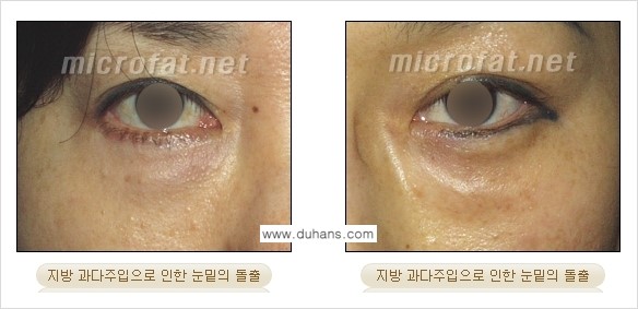 [두한성형외과 경쟁력 미세지방이식] - [타병원에서의 미세지방이식 이후 부작용 교정의 대상 안내] 관련 이미지 3
