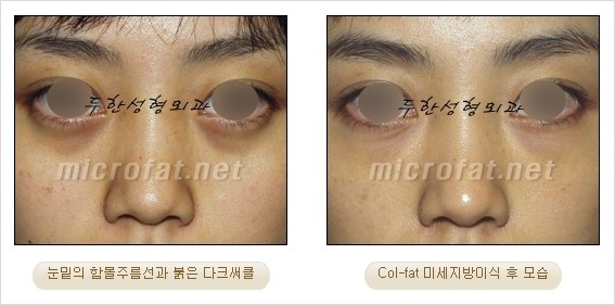 ​[두한성형외과 경쟁력 눈밑성형 리더] - [눈밑 다크써클의 증상, 원인, 종류, 치료방법 안내] 관련 이미지 31