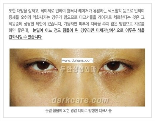 [두한성형외과 경쟁력 다크써클 교정] - [다크써클의 원인 안내] 관련 이미지 7