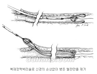 [두한성형외과 정맥류] - [정맥류 시술안내] 관련 이미지 2