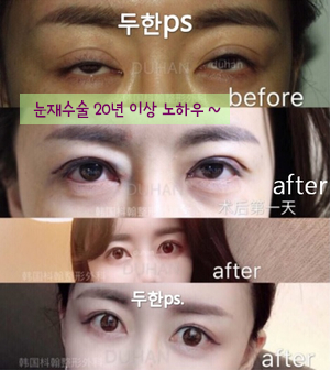 Best Place for Revision Eyelid Surgery, Duhan Plastic Surgery - Lowering Double Eyelid Line image 28