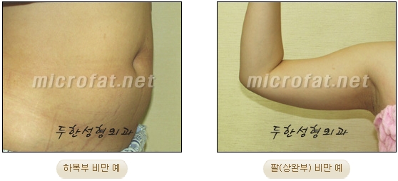 두한성형외과 지방흡입 - 부위별 안전 지방흡입 관련 이미지 2