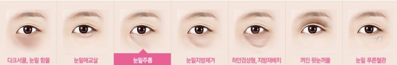[두한성형외과 다크서클] - [다크서클 전후사진 검증] 관련 이미지 67