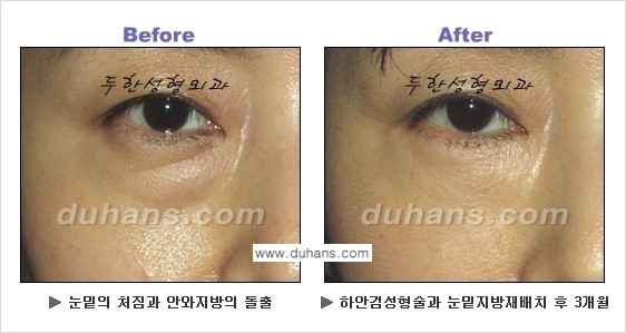 [두한성형외과의 상큼하고 환한 젊은 눈매완성] - [하안검 성형술 ①] 관련 이미지 2