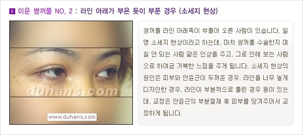 [두한성형외과 경쟁력 쌍꺼풀 재수술, 극한 눈재수술] - [자연스러운 눈매로의 복원 쌍꺼풀 재수술 대상 안내] 관련 이미지 3