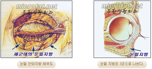 두한성형외과 눈밑성형 - 눈밑지방제거, 눈밑주름, 눈밑지방재배치 관련 이미지 2