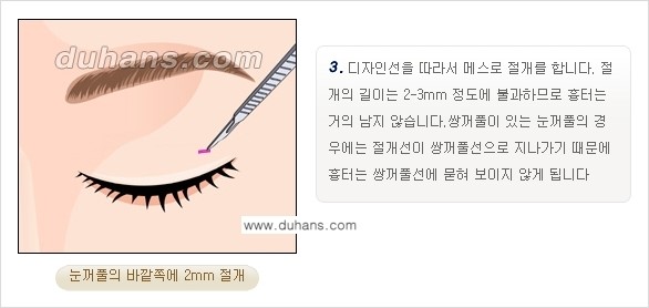 [두한성형외과 경쟁력 지방제거, 지방재배치] - [상큼하고 젊은 눈매 만들기 안내] 관련 이미지 5