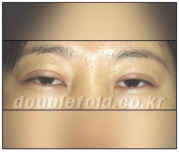 [Duhan Plastic Surgery Double Eyelid Revision Surgery] - [Ptosis Correction Surgery] image 6
