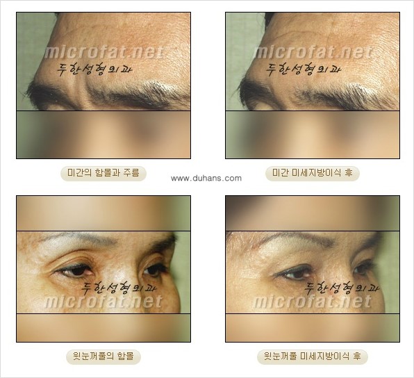 [두한성형외과] - [두한 지방이식의 자부심 콜펫(Col-fat)지방이식] 관련 이미지 8