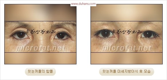 [두한성형외과 경쟁력 눈성형 리더] - [윗눈꺼풀 함몰( #꺼진눈꺼풀) 미세지방이식과 상안검성형]#꺼진눈성형 , #눈위함몰 관련 이미지 9