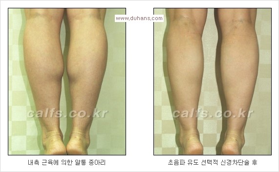 [두한성형외과 Dr. 컬럼] - [종아리 근육퇴축술로 가장 선호하는 비절개 초음파 유도 선택적 신경차단술] 관련 이미지 19