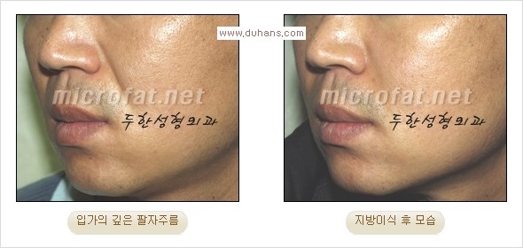 [두한성형외과 경쟁력 주름성형] - [입가와 팔자의 주름제거 지방이식 1.] 관련 이미지 7