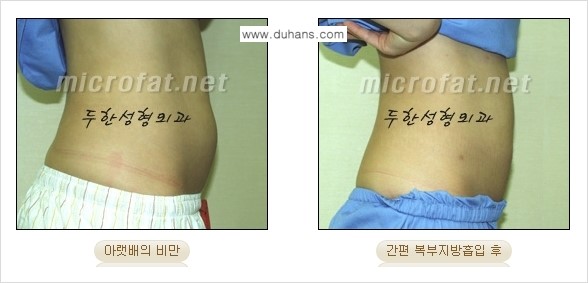 [두한성형외과 겨울엔 지방흡입] - [간편한 복부지방흡입 도전 2.] 관련 이미지 9