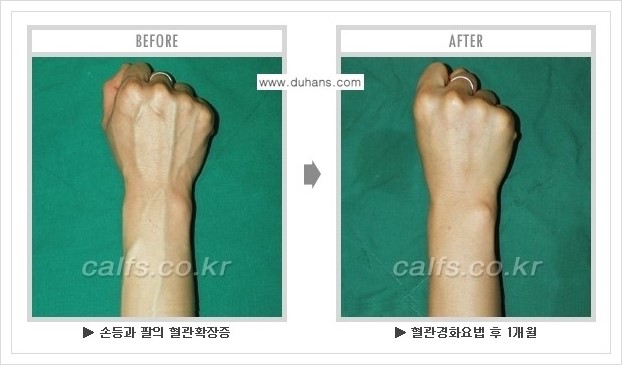 ⁠⁠[두한성형외과 정맥류 치료] - [손, 팔 정맥확장증 사진자료 안내 ②] 관련 이미지 5
