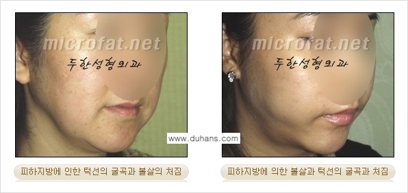 [두한성형외과 경쟁력 미세지방흡입] - [안면부의 안전한 미세지방흡입 안내] 관련 이미지 2