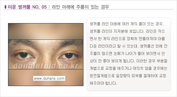 [두한성형외과 경쟁력 눈성형] - [미운 쌍꺼풀이란?] 관련 이미지 6