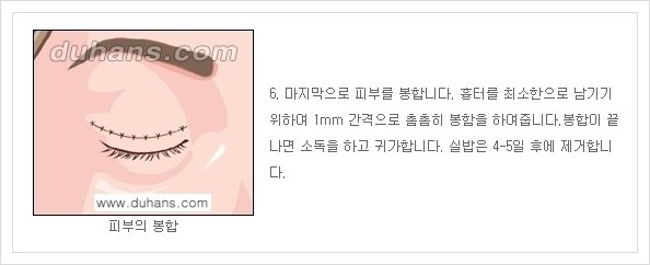 [두한성형외과 경쟁력 안검성형] - [상큼하고 환한 눈매의 완성 상안검 성형술 안내] 관련 이미지 6