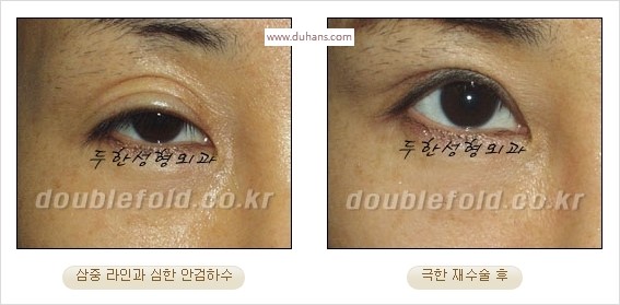 [두한성형외과 경쟁력 쌍꺼풀 재수술 스페셜] - [망가진 라인을 교정하는 극한 재수술] 관련 이미지 24