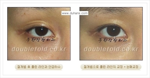 [두한성형외과 경쟁력 쌍꺼풀 재수술, 극한 재수술] - [쌍꺼풀 라인이 풀렸을 경우 쌍꺼풀 재수술 안내] 관련 이미지 6