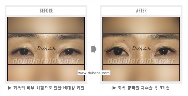 [두한성형외과 쌍꺼풀 재수술] - [지나친 아웃폴드 라인의 쌍꺼풀 재수술] 관련 이미지 8