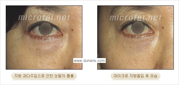 [두한성형외과 경쟁력 미세지방이식] - [미세지방이식 부작용 종류와 교정방법 안내] 관련 이미지 11
