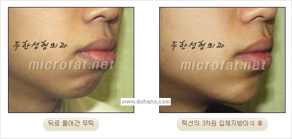 ⁠⁠[두한성형외과 경쟁력 미세지방이식] - [턱 미세지방이식 - 안면윤곽 교정 안내] 관련 이미지 23