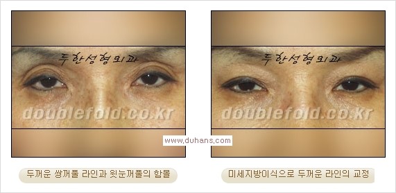 [두한성형외과 경쟁력 쌍꺼풀 재수술] - [쌍꺼풀 재수술 과정] 관련 이미지 93
