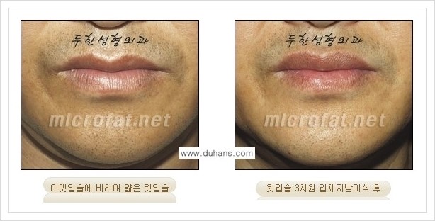 [두한성형외과 경쟁력 미세지방이식] - [입술 미세지방이식 안내] 관련 이미지 3