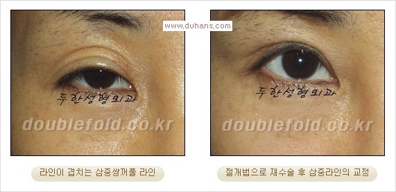 [두한성형외과 경쟁력 쌍꺼풀 재수술] - [삼중(세겹) 쌍꺼풀 라인, 눈꺼풀이 함몰된 삼중(세겹) 쌍꺼풀 라인 교정] 관련 이미지 5