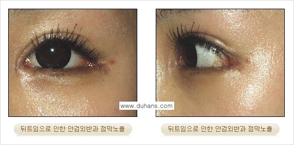 [두한성형외과 경쟁력 눈성형] - [뒤트임 수술 부작용 안내] 관련 이미지 6