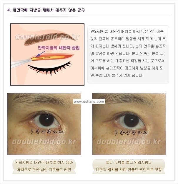 [두한성형외과 경쟁력 쌍꺼풀 재수술, 극한 재수술] - [쌍꺼풀 재수술 실패 원인(Cause of reoperation fail) 안내] 관련 이미지 4