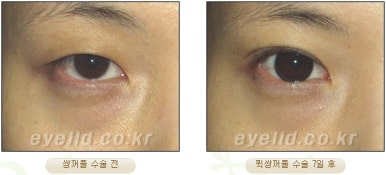 [Double Eyelid Surgery Duhan Plastic Surgery] - [Buried Method, Incision Method, Partial Incision Method] image 19