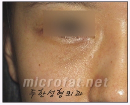 [두한성형외과 지방이식] - [다크서클, 눈밑주름] 관련 이미지 46