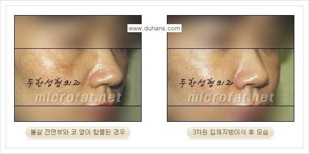 [두한성형외과 경쟁력 미세지방이식] - [귀족수술과 인디언밴드(앞광대주름) 미세지방이식] 관련 이미지 13