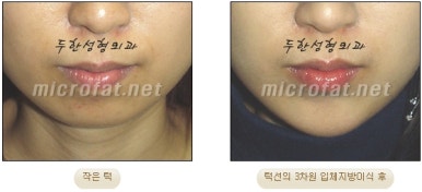 [Duhan Plastic Surgery Clinic Microgenia Correction] - [Chin Microfat Grafting] image 23